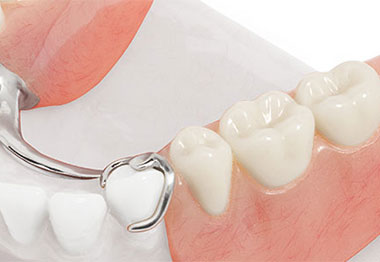 Partial Dentures